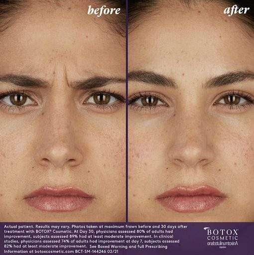 Before & After BOTOX