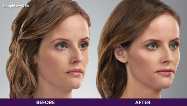 Before & After Juvederm