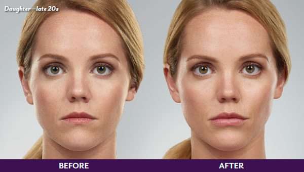 Before & After Juvederm